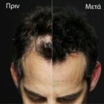 Toppik Ίνες Κάλυψης Αραίωσης Μαλλιών 12gr Toppik Ίνες Κάλυψης Αραίωσης Μαλλιών 12gr